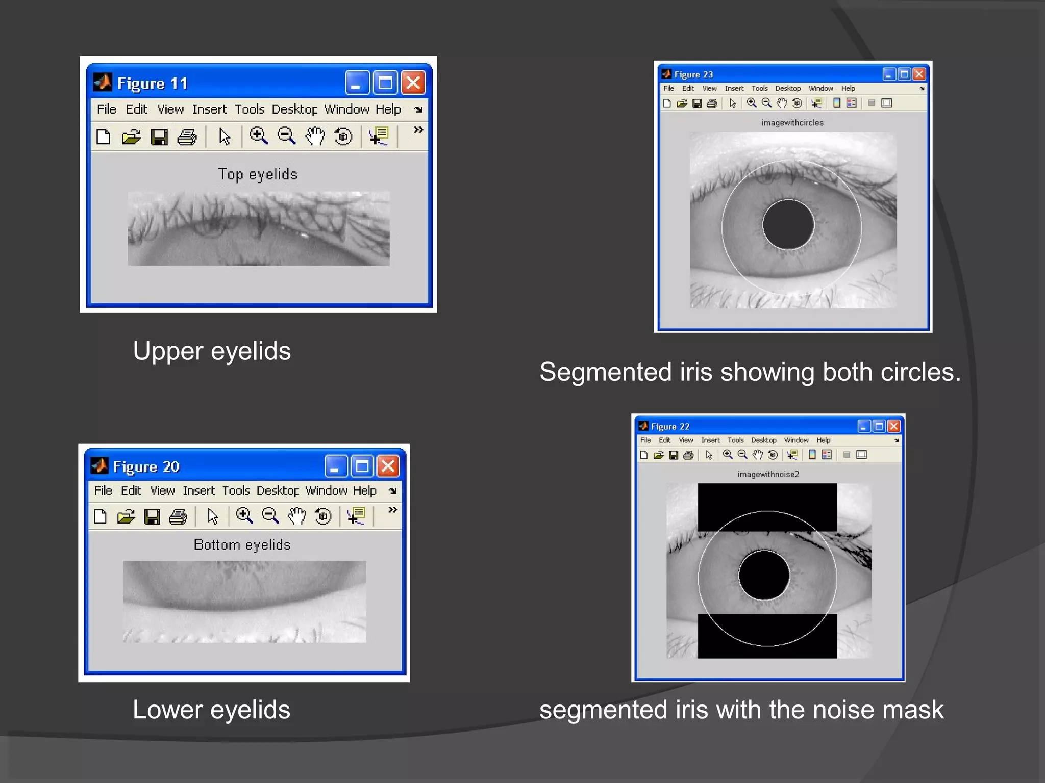Upper eyelids 
Segmented iris showing both circles. 
Lower eyelids segmented iris with the noise mask 
 