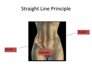 Straight Line Principle
Surgeon
Pathology
Monitor
 