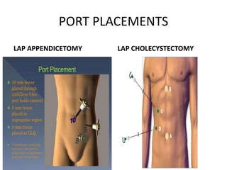 PORT PLACEMENTS
LAP APPENDICETOMY LAP CHOLECYSTECTOMY
 