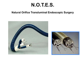 N.O.T.E.S.
Natural Orifice Transluminal Endoscopic Surgery
 