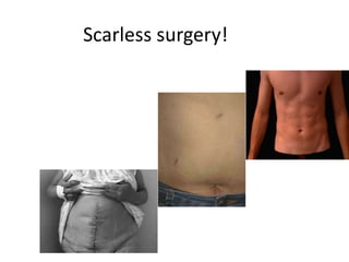 Scarless surgery!
 