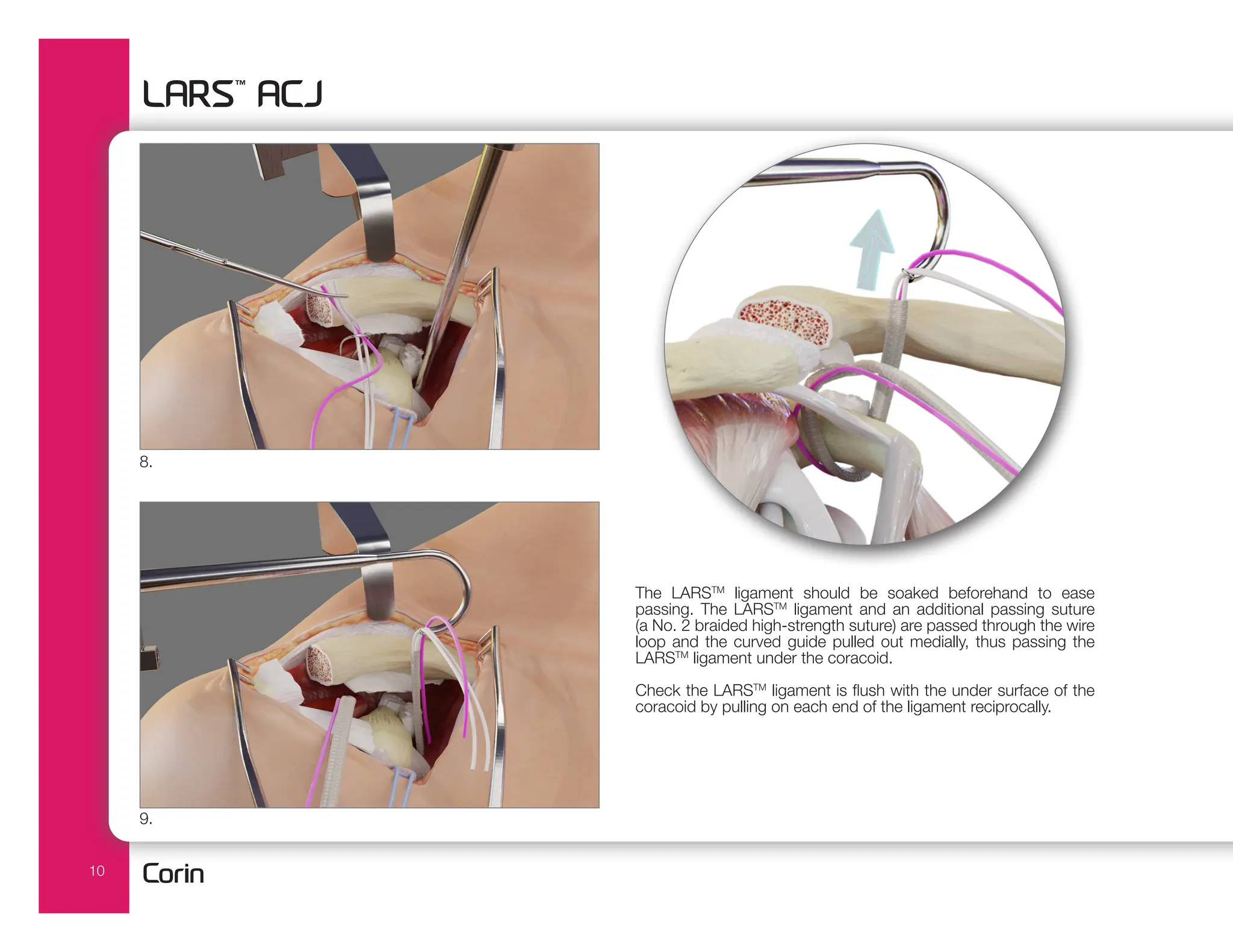 10
The LARSTM
ligament should be soaked beforehand to ease
passing. The LARSTM
ligament and an additional passing suture
(a No. 2 braided high-strength suture) are passed through the wire
loop and the curved guide pulled out medially, thus passing the
LARSTM
ligament under the coracoid.
Check the LARSTM
ligament is flush with the under surface of the
coracoid by pulling on each end of the ligament reciprocally.
9.
8.
 
