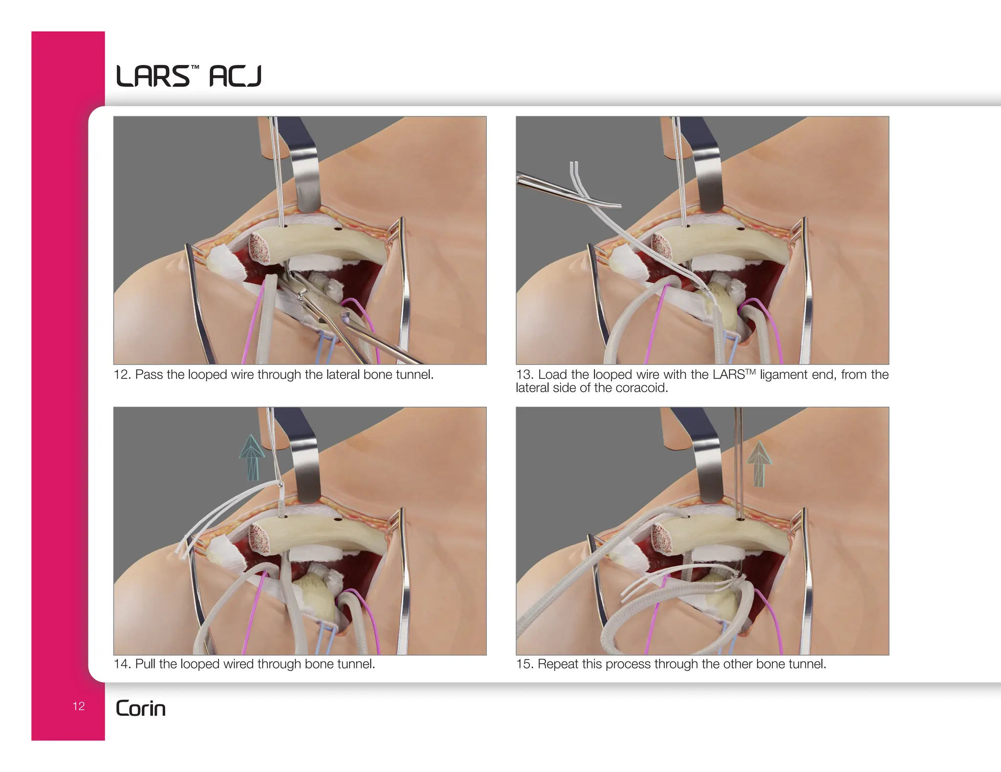 12
13. Load the looped wire with the LARSTM
ligament end, from the
lateral side of the coracoid.
14. Pull the looped wired through bone tunnel.
12. Pass the looped wire through the lateral bone tunnel.
15. Repeat this process through the other bone tunnel.
 