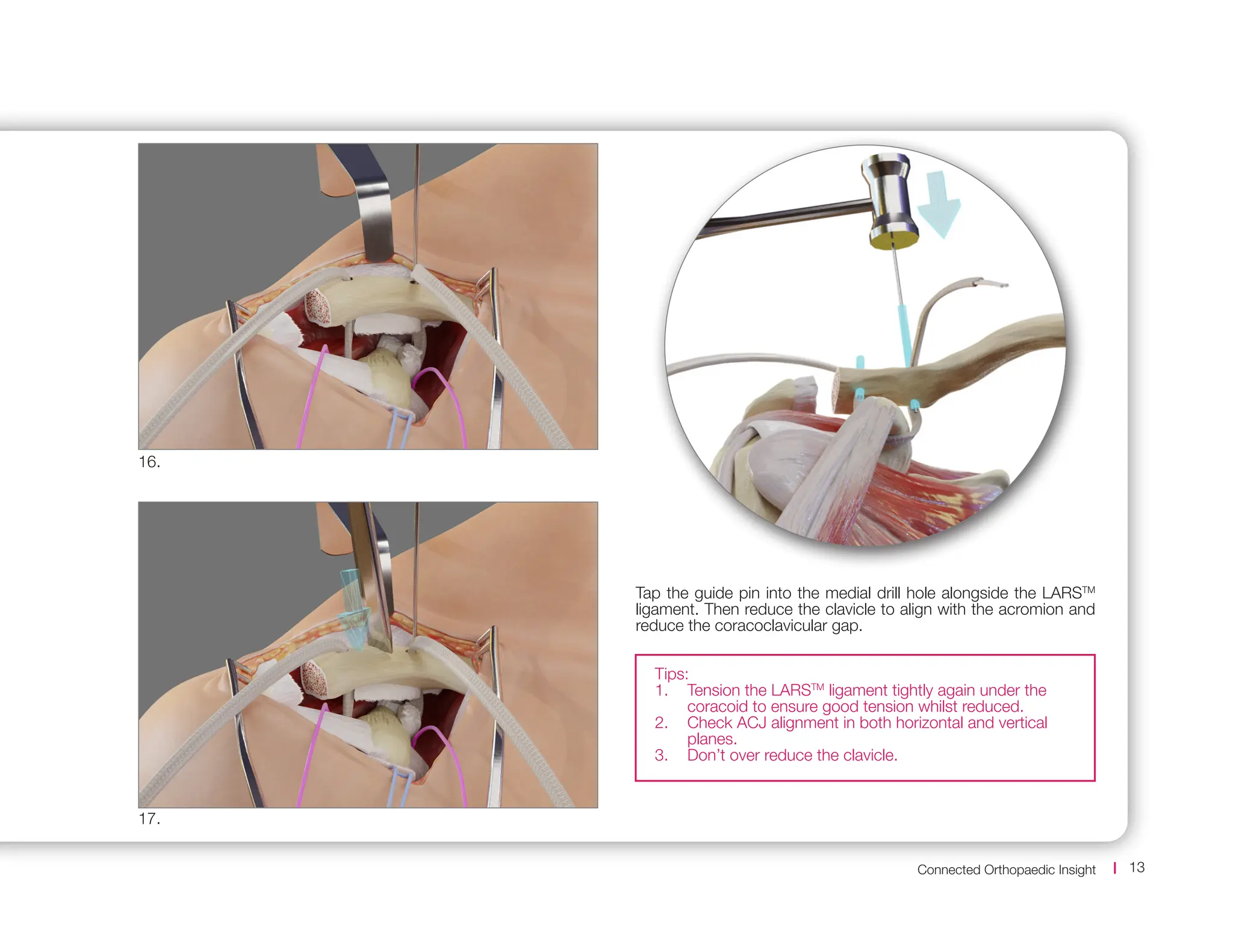 Connected Orthopaedic Insight 13
Tap the guide pin into the medial drill hole alongside the LARSTM
ligament. Then reduce the clavicle to align with the acromion and
reduce the coracoclavicular gap.
17.
16.
Tips:
1. Tension the LARSTM
ligament tightly again under the
coracoid to ensure good tension whilst reduced.
2. Check ACJ alignment in both horizontal and vertical
planes.
3. Don’t over reduce the clavicle.
 