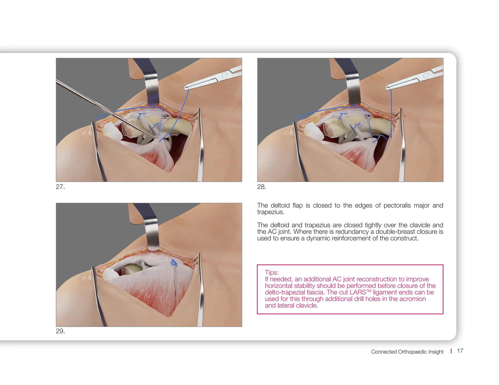 Connected Orthopaedic Insight 17
The deltoid flap is closed to the edges of pectoralis major and
trapezius.
The deltoid and trapezius are closed tightly over the clavicle and
the AC joint. Where there is redundancy a double-breast closure is
used to ensure a dynamic reinforcement of the construct.
28.
29.
27.
Tips:
If needed, an additional AC joint reconstruction to improve
horizontal stability should be performed before closure of the
delto-trapezial fascia. The cut LARSTM
ligament ends can be
used for this through additional drill holes in the acromion
and lateral clavicle.
 