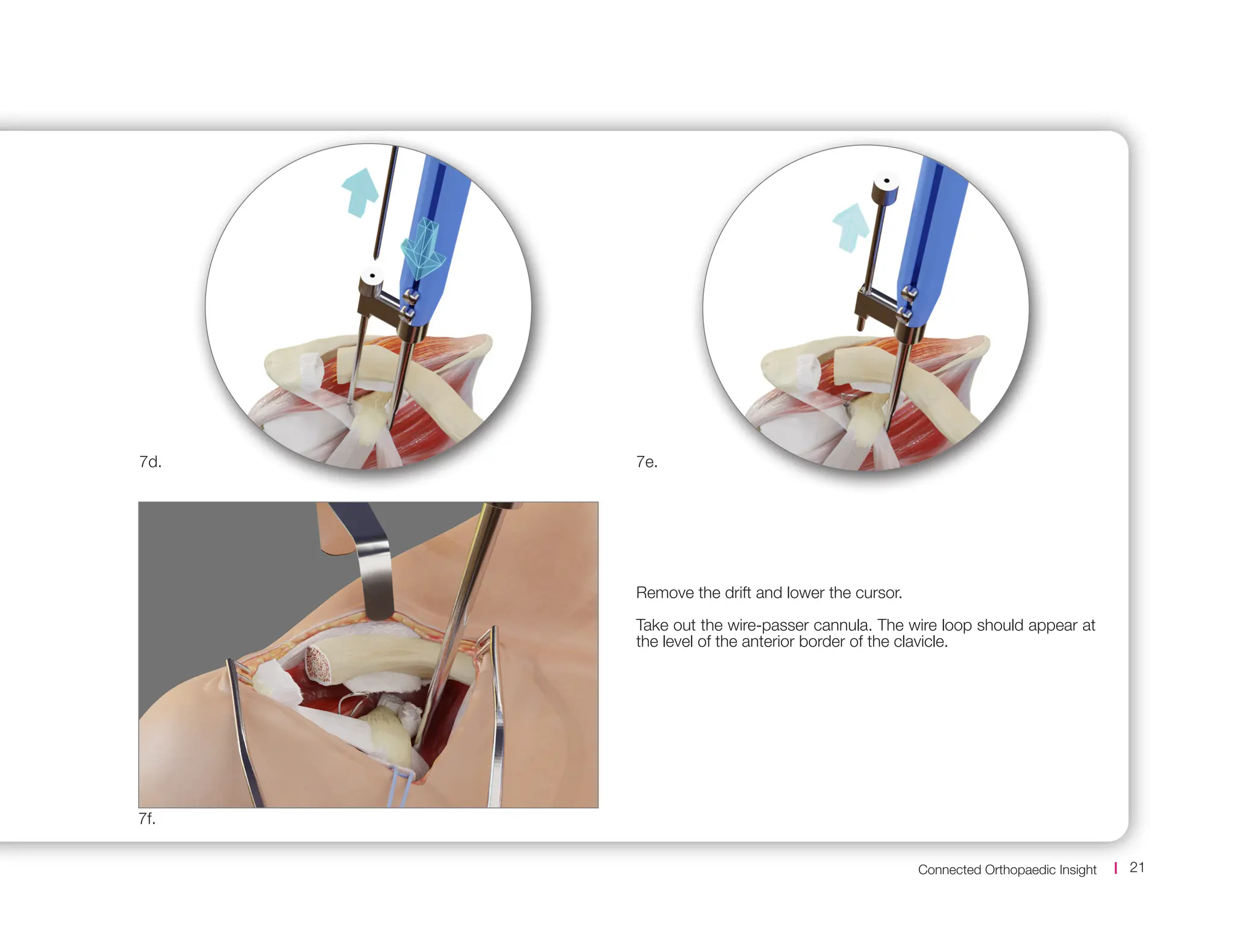 Connected Orthopaedic Insight 21
Remove the drift and lower the cursor.
Take out the wire-passer cannula. The wire loop should appear at
the level of the anterior border of the clavicle.
7e.
7f.
7d.
 