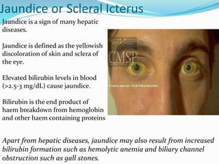 Jaundice or Scleral Icterus
Jaundice is a sign of many hepatic
diseases.
Jaundice is defined as the yellowish
discoloration of skin and sclera of
the eye.
Elevated bilirubin levels in blood
(>2.5-3 mg/dL) cause jaundice.
Bilirubin is the end product of
haem breakdown from hemoglobin
and other haem containing proteins
Apart from hepatic diseases, jaundice may also result from increased
bilirubin formation such as hemolytic anemia and biliary channel
obstruction such as gall stones.
 