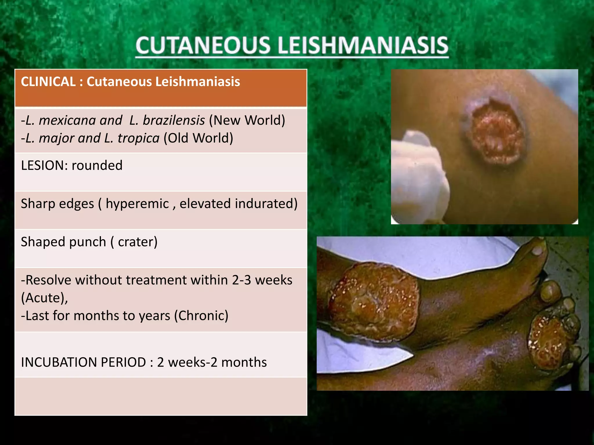 CLINICAL : Cutaneous Leishmaniasis
-L. mexicana and L. brazilensis (New World)
-L. major and L. tropica (Old World)
LESION: rounded
Sharp edges ( hyperemic , elevated indurated)
Shaped punch ( crater)
-Resolve without treatment within 2-3 weeks
(Acute),
-Last for months to years (Chronic)
INCUBATION PERIOD : 2 weeks-2 months
 