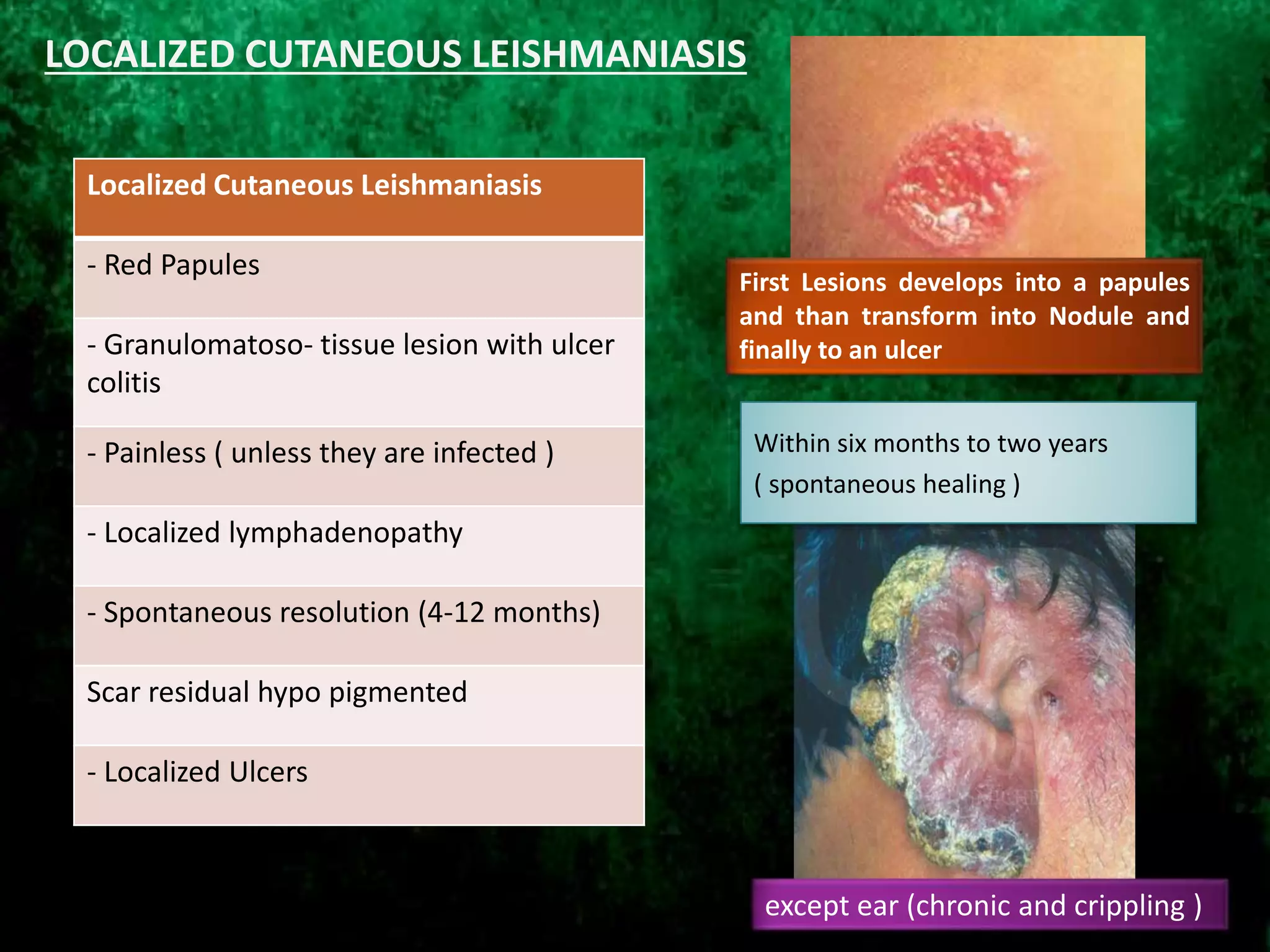 First Lesions develops into a papules
and than transform into Nodule and
finally to an ulcer
Localized Cutaneous Leishmaniasis
- Red Papules
- Granulomatoso- tissue lesion with ulcer
colitis
- Painless ( unless they are infected )
- Localized lymphadenopathy
- Spontaneous resolution (4-12 months)
Scar residual hypo pigmented
- Localized Ulcers
Within six months to two years
( spontaneous healing )
except ear (chronic and crippling )
LOCALIZED CUTANEOUS LEISHMANIASIS
 