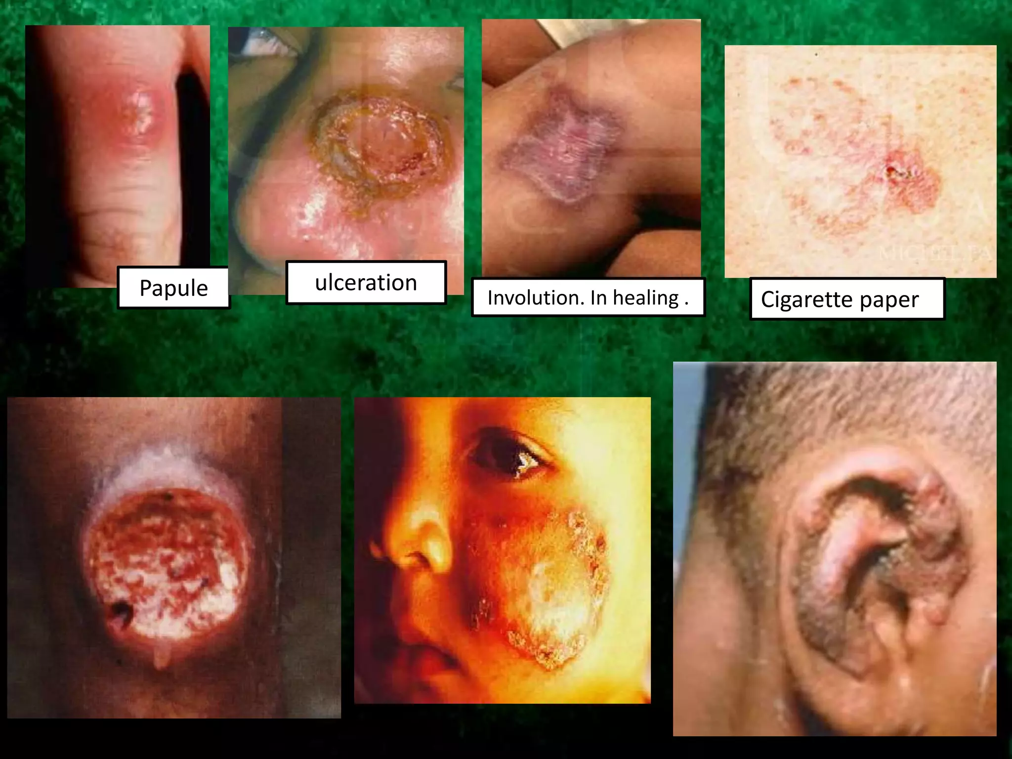 Papule ulceration
Involution. In healing . Cigarette paper
 