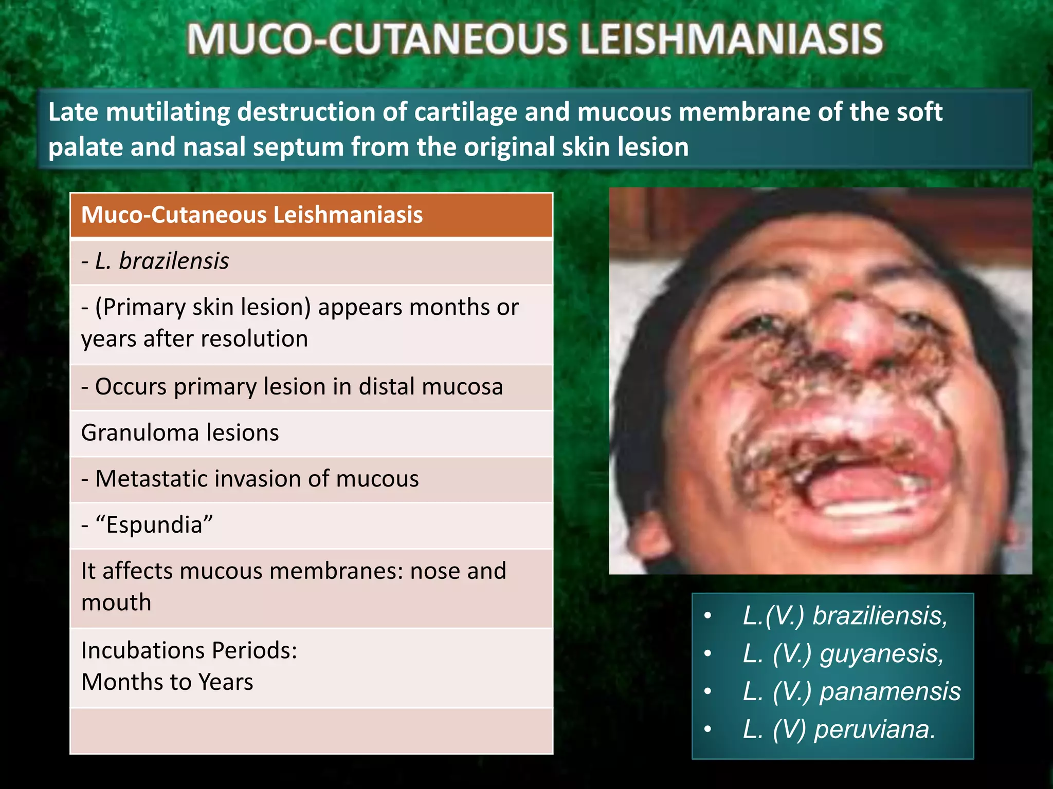 • L.(V.) braziliensis,
• L. (V.) guyanesis,
• L. (V.) panamensis
• L. (V) peruviana.
Late mutilating destruction of cartilage and mucous membrane of the soft
palate and nasal septum from the original skin lesion
Muco-Cutaneous Leishmaniasis
- L. brazilensis
- (Primary skin lesion) appears months or
years after resolution
- Occurs primary lesion in distal mucosa
Granuloma lesions
- Metastatic invasion of mucous
- “Espundia”
It affects mucous membranes: nose and
mouth
Incubations Periods:
Months to Years
 