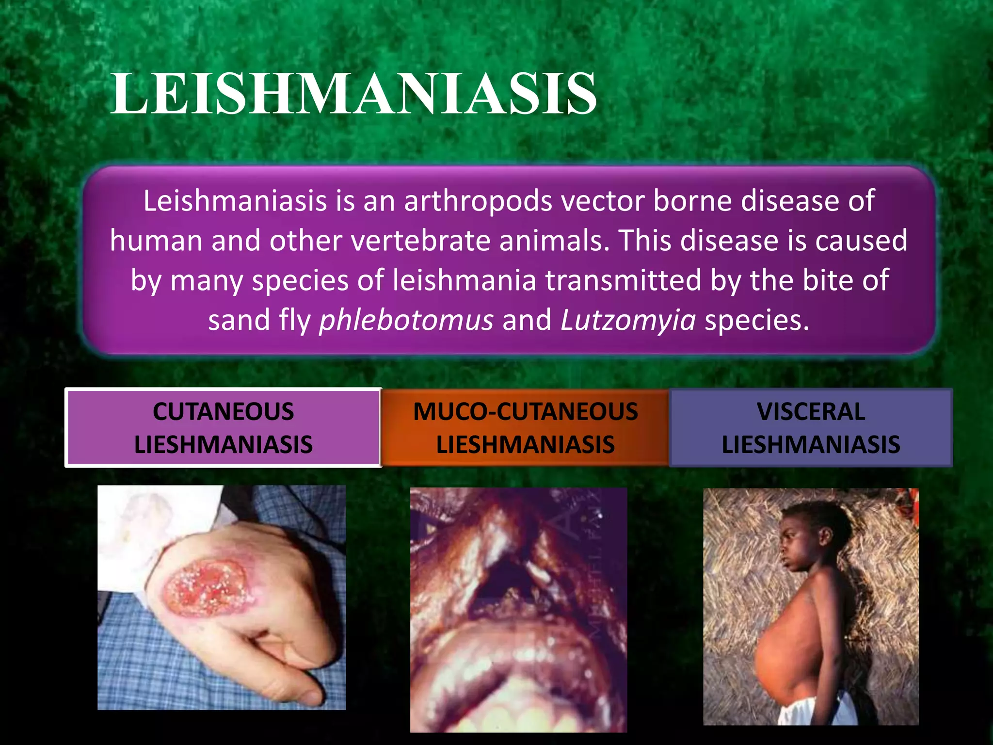 Leishmaniasis is an arthropods vector borne disease of
human and other vertebrate animals. This disease is caused
by many species of leishmania transmitted by the bite of
sand fly phlebotomus and Lutzomyia species.
CUTANEOUS
LIESHMANIASIS
MUCO-CUTANEOUS
LIESHMANIASIS
VISCERAL
LIESHMANIASIS
LEISHMANIASIS
 