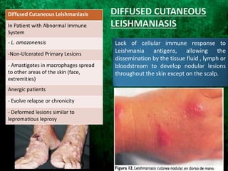 Lack of cellular immune response to
Leishmania antigens, allowing the
dissemination by the tissue fluid , lymph or
bloodstream to develop nodular lesions
throughout the skin except on the scalp.
Diffused Cutaneous Leishmaniasis
In Patient with Abnormal Immune
System
- L. amazonensis
-Non-Ulcerated Primary Lesions
- Amastigotes in macrophages spread
to other areas of the skin (face,
extremities)
Anergic patients
- Evolve relapse or chronicity
- Deformed lesions similar to
lepromatious leprosy
DIFFUSED CUTANEOUS
LEISHMANIASIS
 