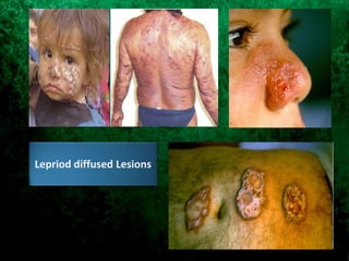 Lepriod diffused Lesions
 