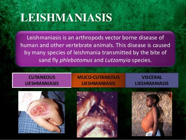 Leishmaniasis and Its Types and Cures