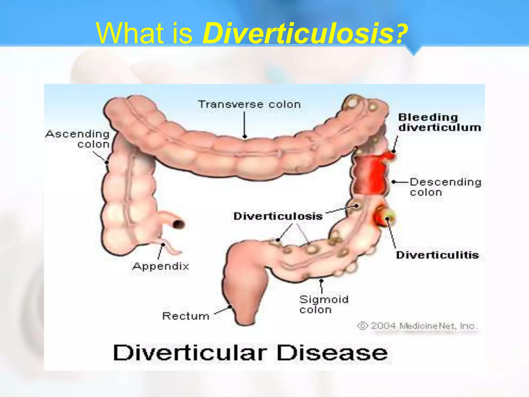 What is Diverticulosis?
 