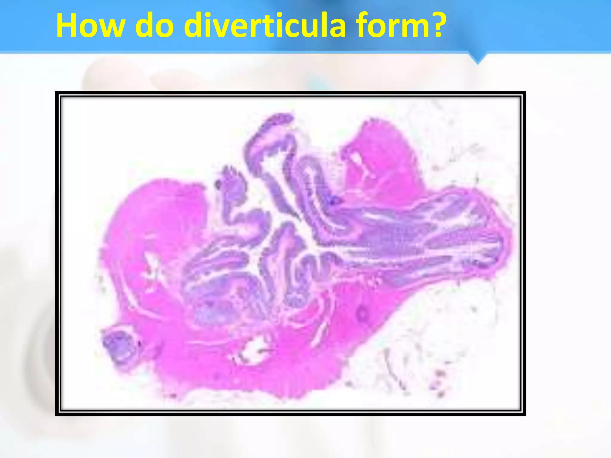 How do diverticula form?
 