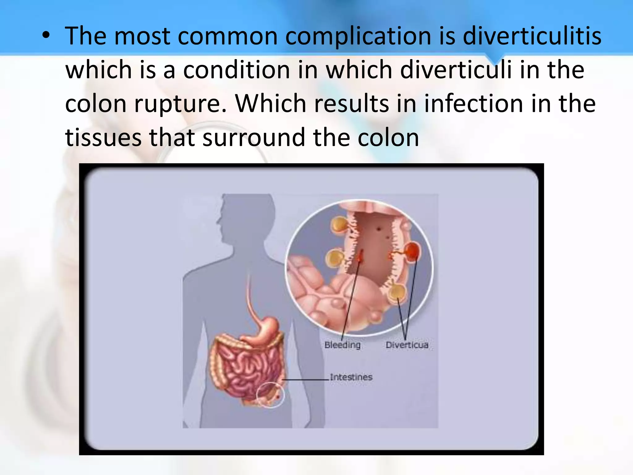 • The most common complication is diverticulitis
  which is a condition in which diverticuli in the
  colon rupture. Which results in infection in the
  tissues that surround the colon
 