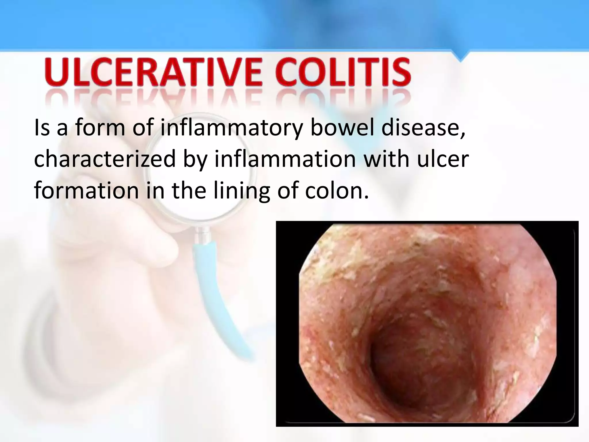 Is a form of inflammatory bowel disease,
characterized by inflammation with ulcer
formation in the lining of colon.
 