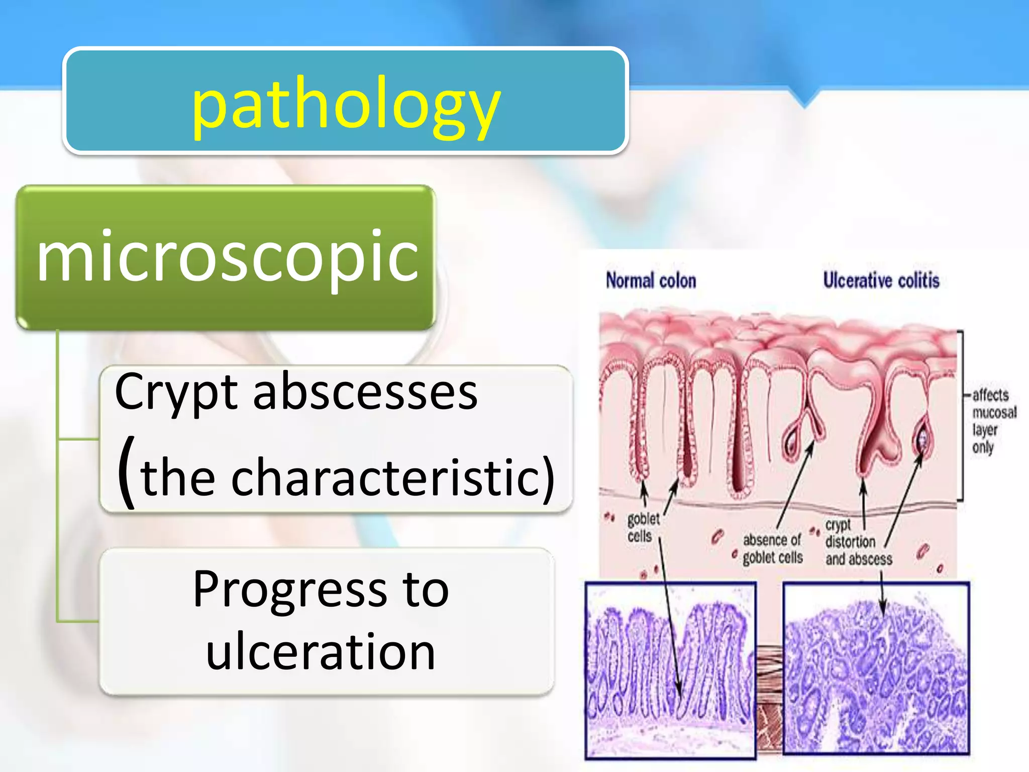 pathology
microscopic
  Crypt abscesses
  (the characteristic)
     Progress to
     ulceration
 