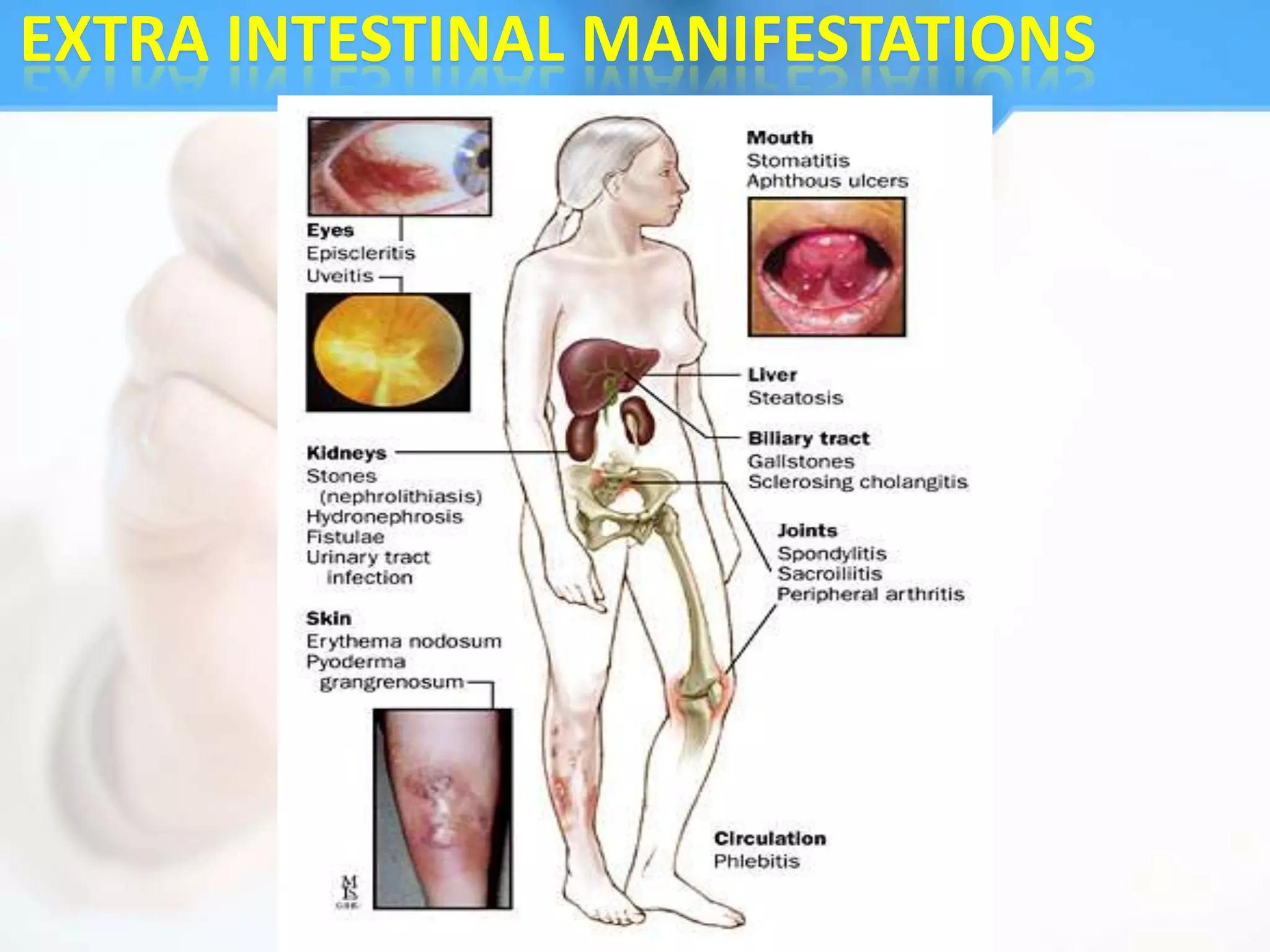 EXTRA INTESTINAL MANIFESTATIONS
 