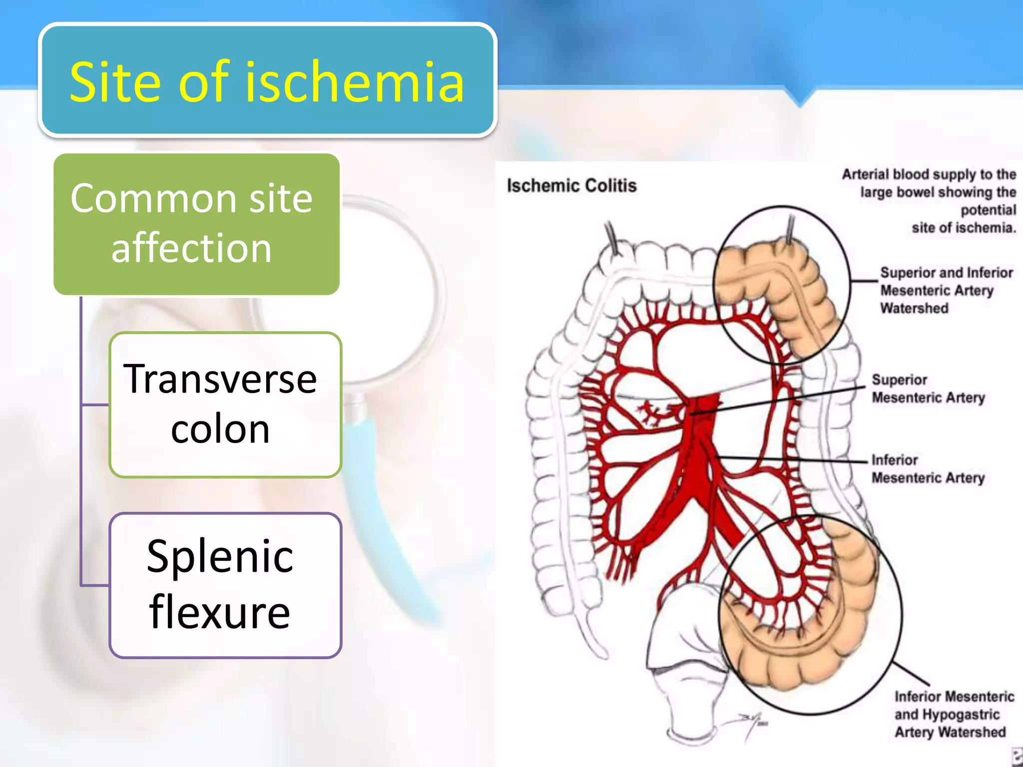 Site of ischemia
Common site
  affection

  Transverse
     colon

   Splenic
   flexure
 