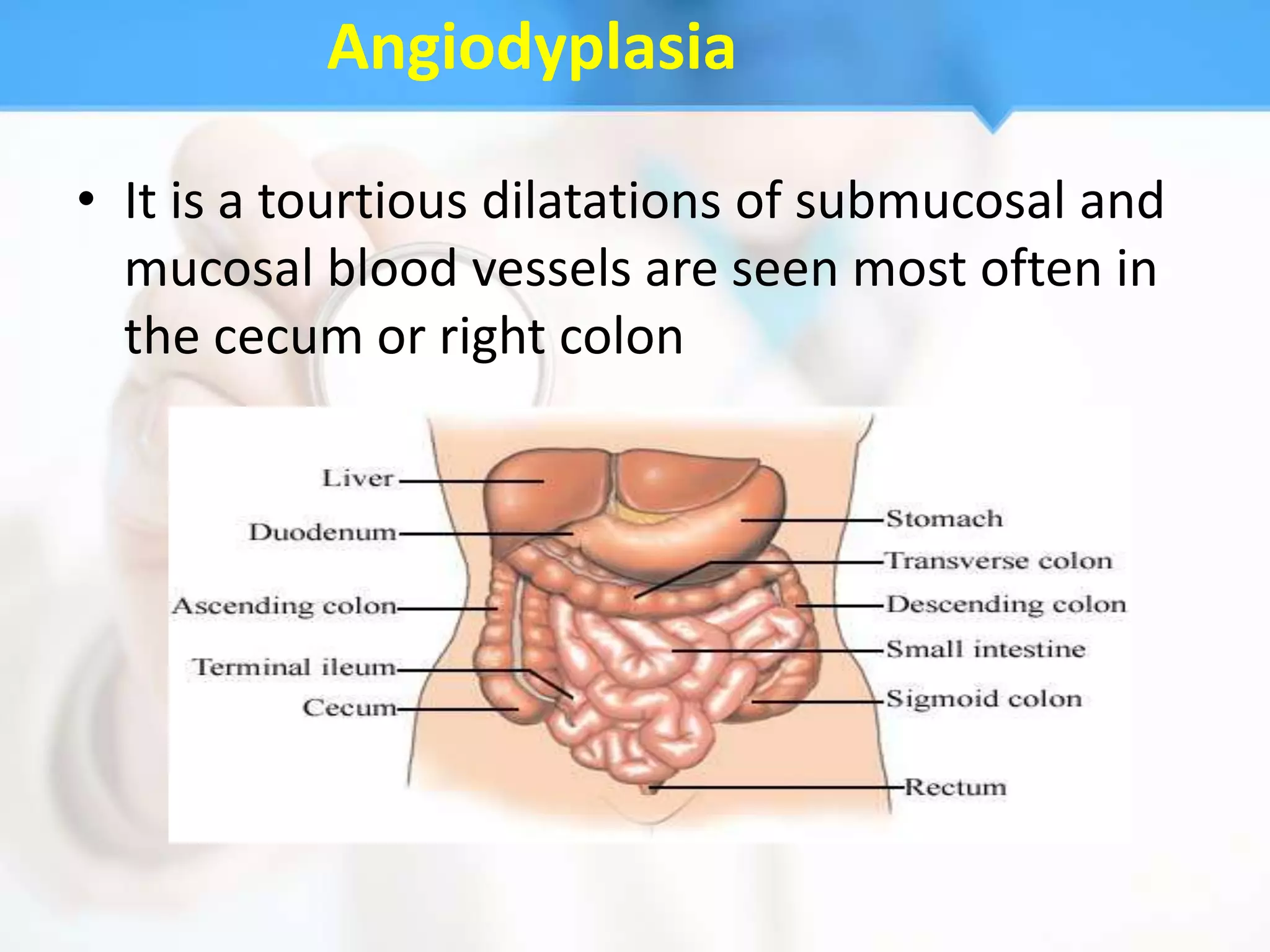 Angiodyplasia

• It is a tourtious dilatations of submucosal and
  mucosal blood vessels are seen most often in
  the cecum or right colon
 