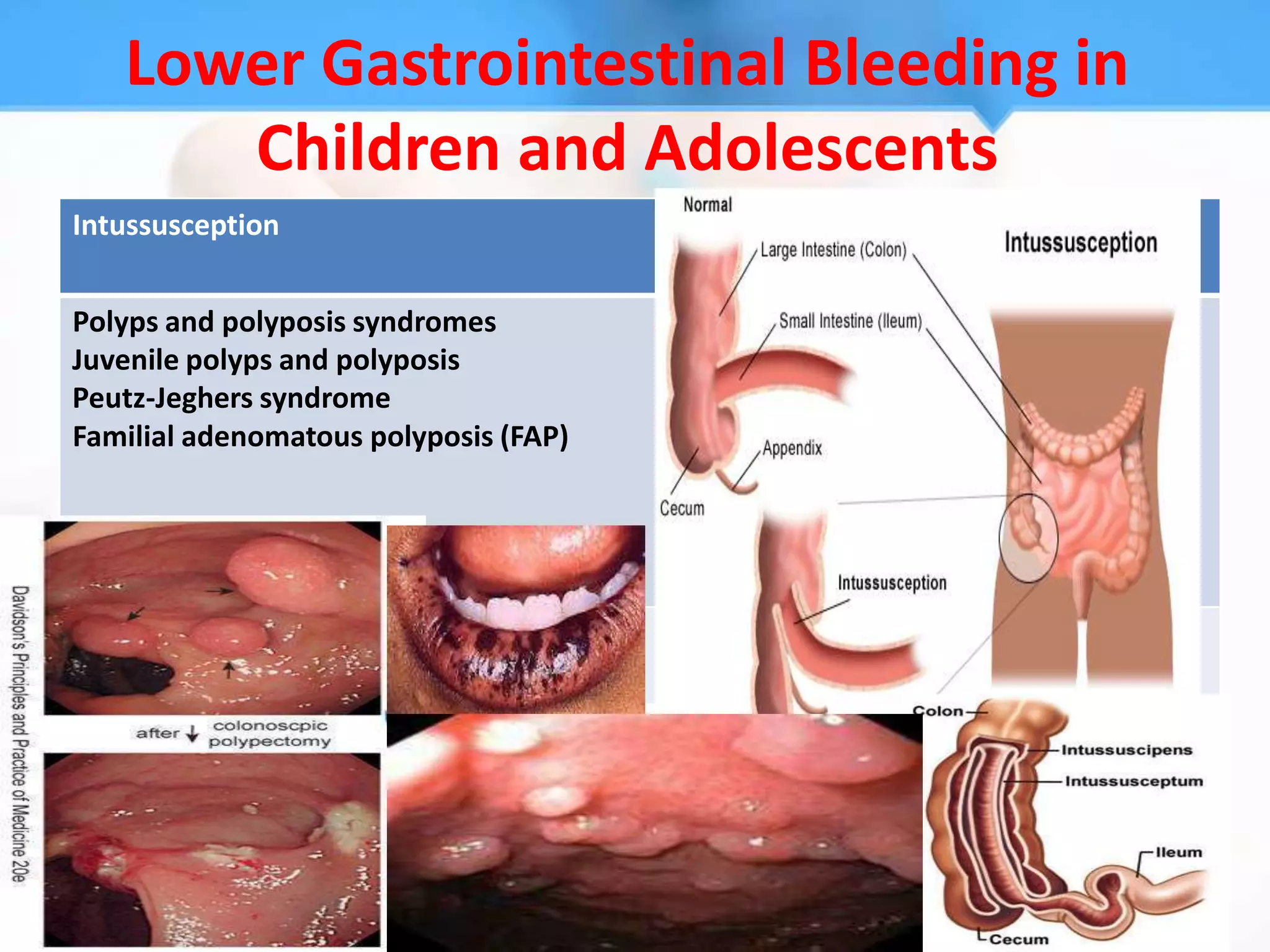 Lower Gastrointestinal Bleeding in
      Children and Adolescents
Intussusception


Polyps and polyposis syndromes
Juvenile polyps and polyposis
Peutz-Jeghers syndrome
Familial adenomatous polyposis (FAP)
 