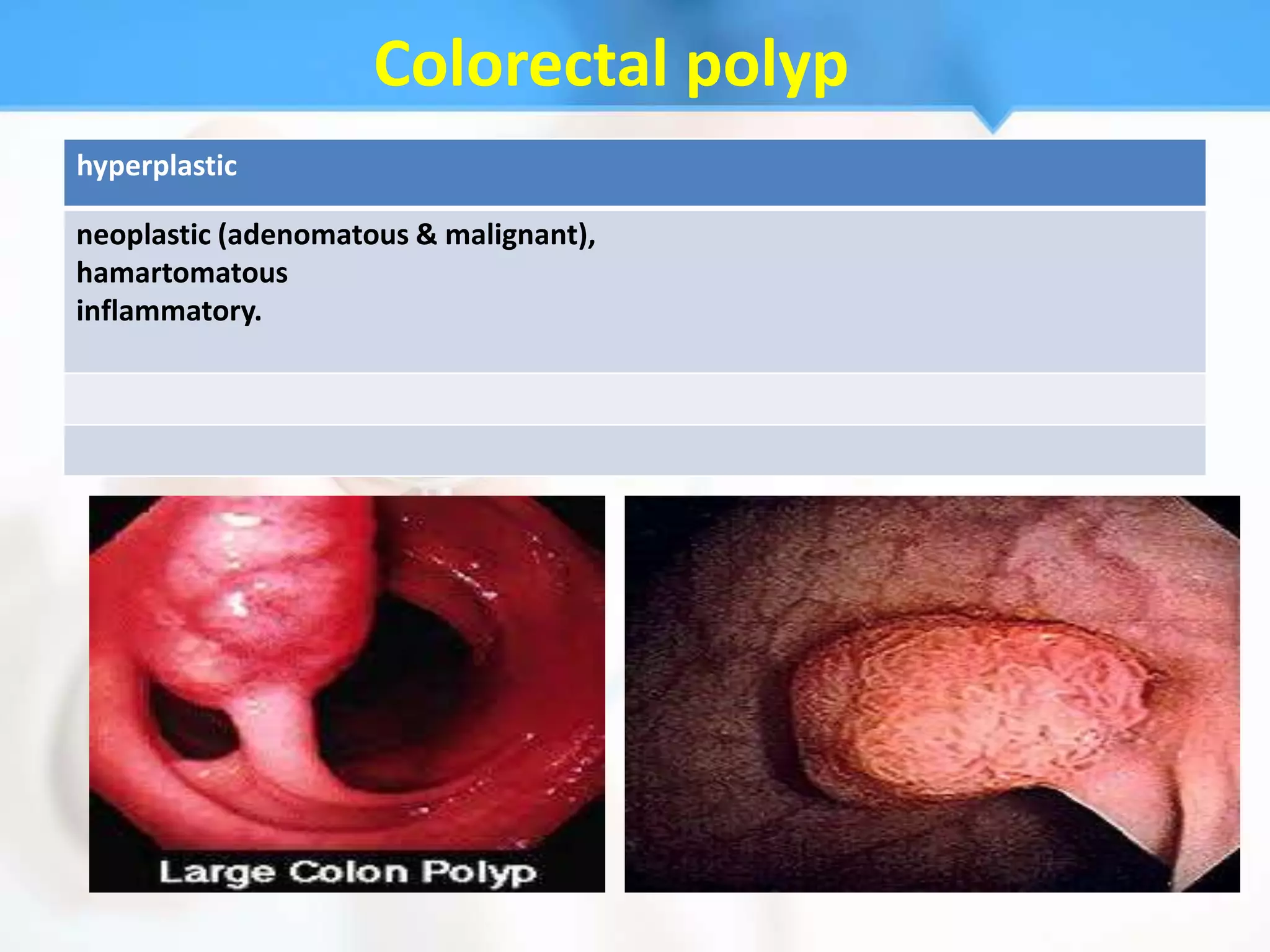 Colorectal polyp
hyperplastic

neoplastic (adenomatous & malignant),
hamartomatous
inflammatory.
 