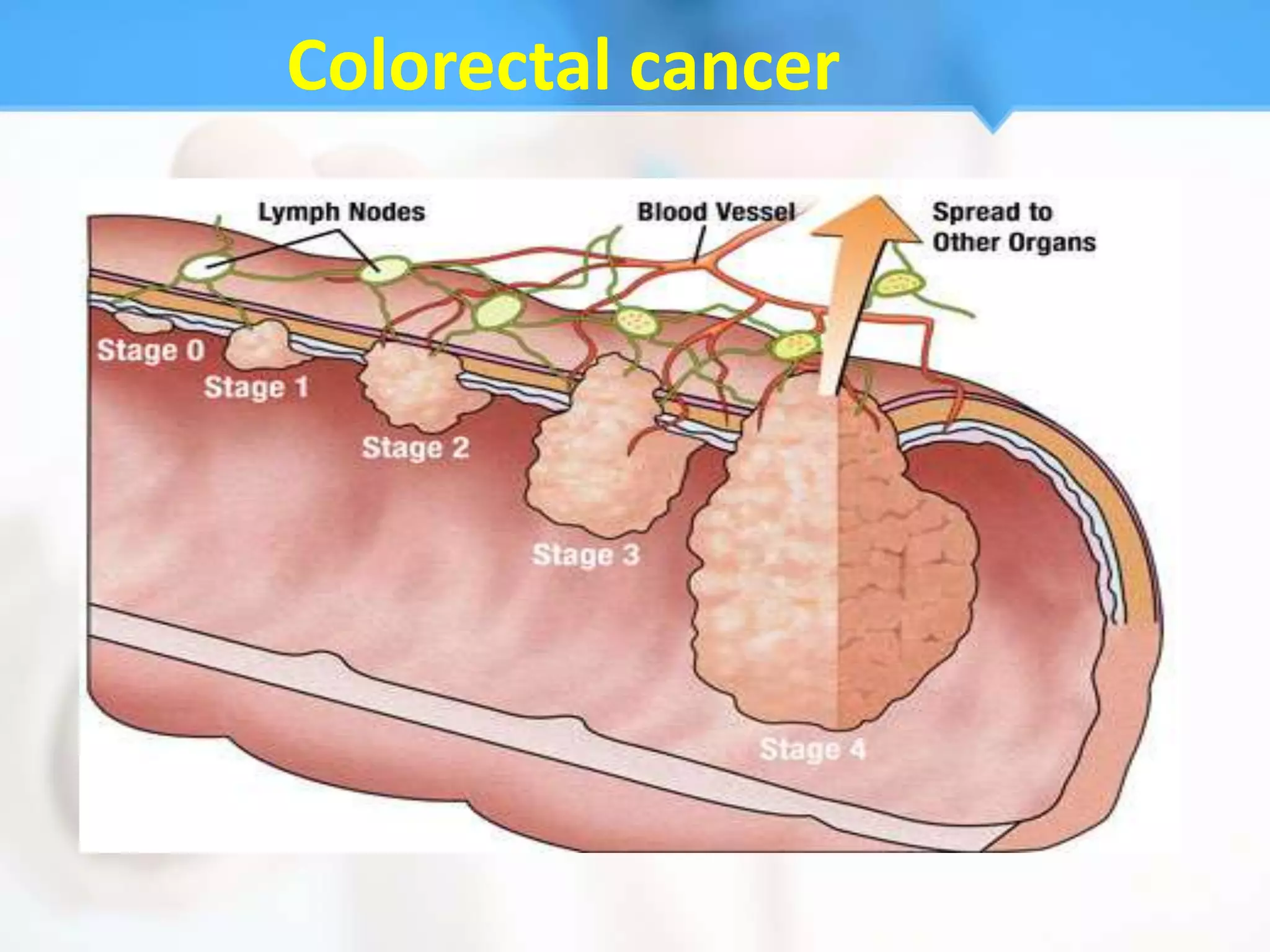 Colorectal cancer
 