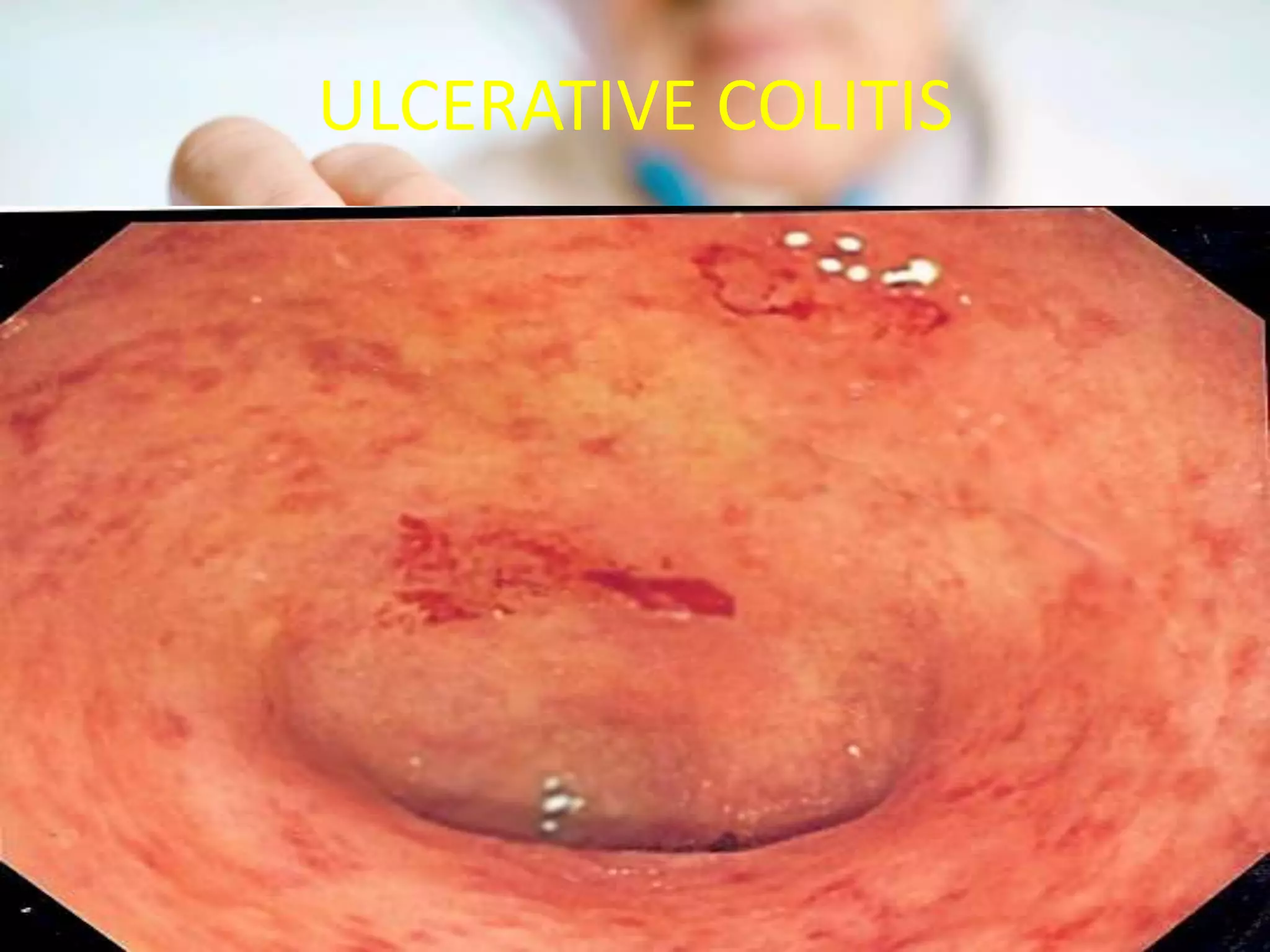 ULCERATIVE COLITIS
 