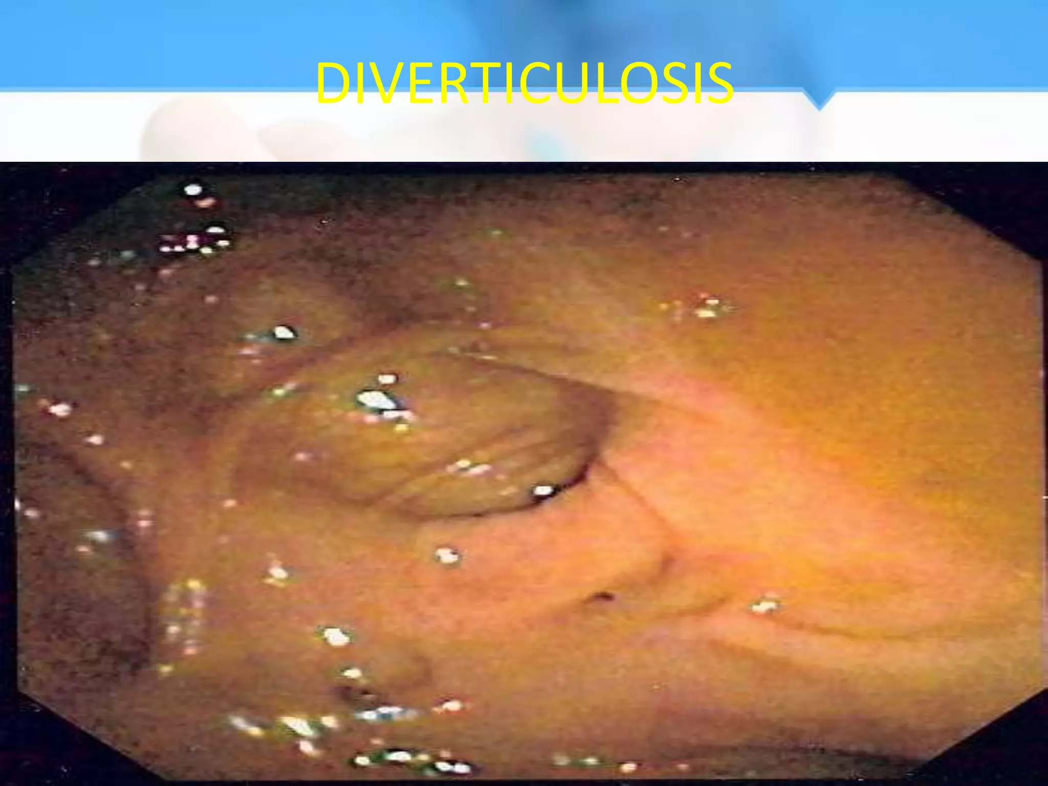 DIVERTICULOSIS
 