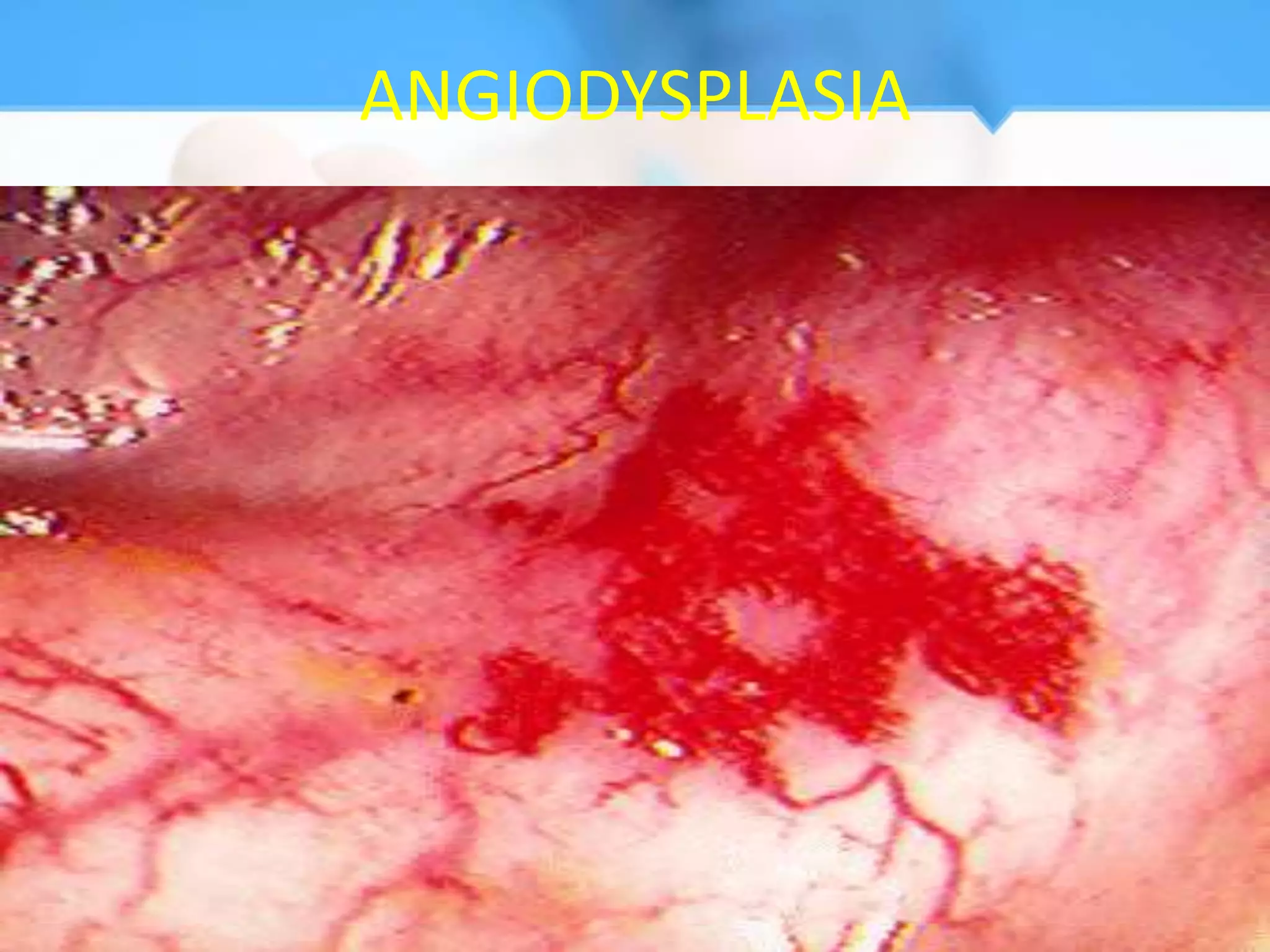 ANGIODYSPLASIA
 