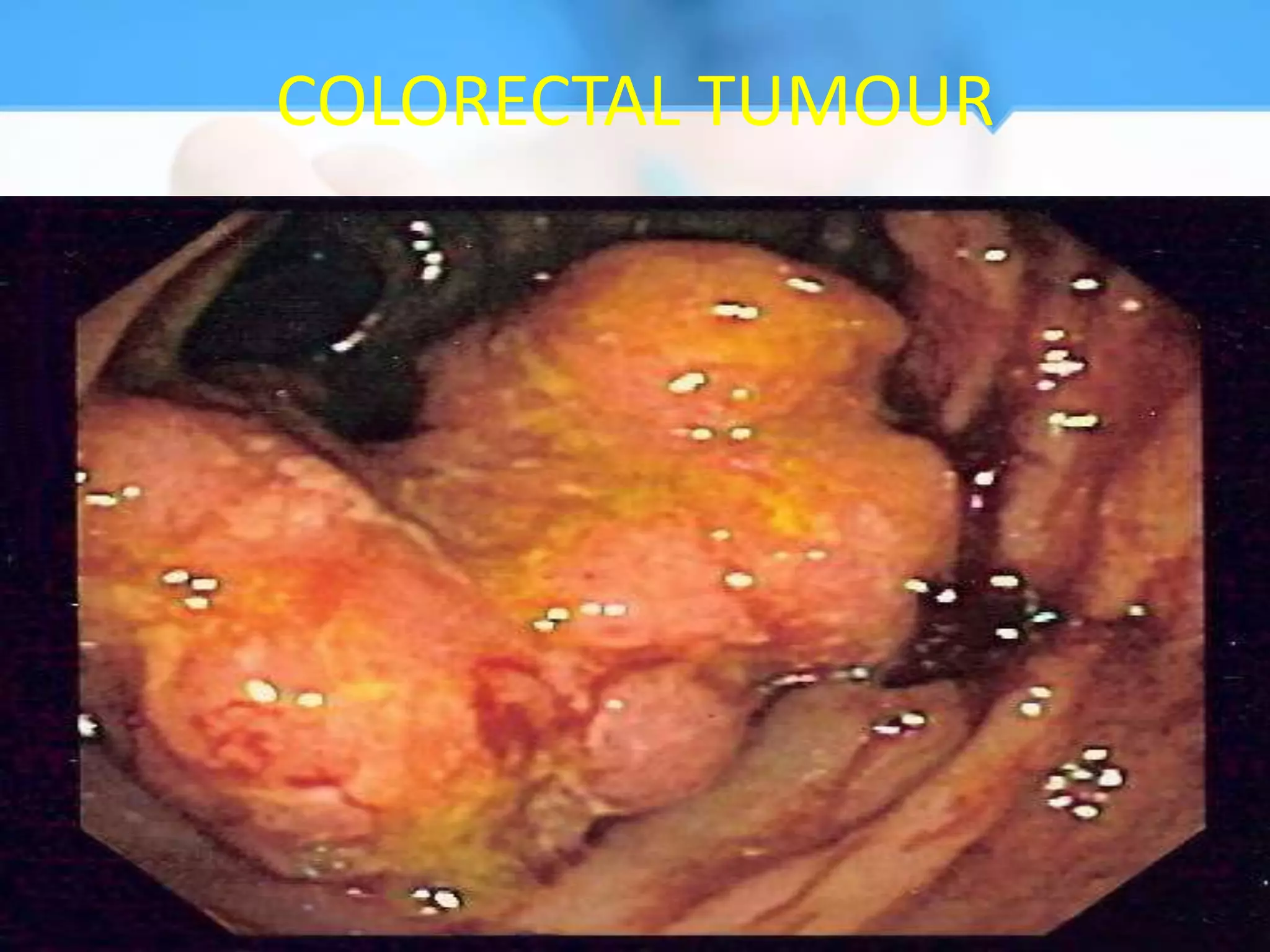 COLORECTAL TUMOUR
 