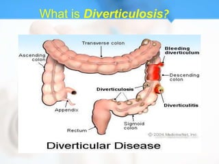 What is Diverticulosis?
 