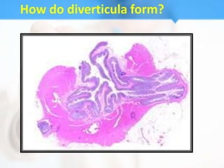 How do diverticula form?
 