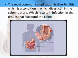 • The most common complication is diverticulitis
  which is a condition in which diverticuli in the
  colon rupture. Which results in infection in the
  tissues that surround the colon
 