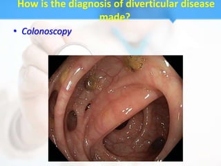 How is the diagnosis of diverticular disease
                 made?
• Colonoscopy
 