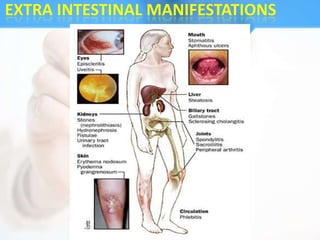 EXTRA INTESTINAL MANIFESTATIONS
 