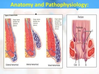 Anatomy and Pathophysiology:
        •
 