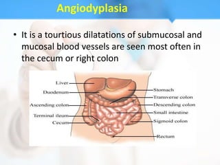 Angiodyplasia

• It is a tourtious dilatations of submucosal and
  mucosal blood vessels are seen most often in
  the cecum or right colon
 