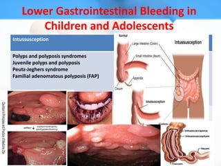 Lower Gastrointestinal Bleeding in
      Children and Adolescents
Intussusception


Polyps and polyposis syndromes
Juvenile polyps and polyposis
Peutz-Jeghers syndrome
Familial adenomatous polyposis (FAP)
 