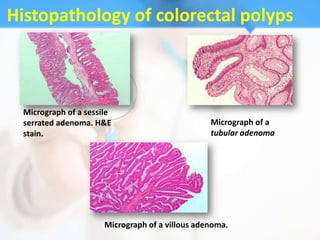 Histopathology of colorectal polyps



  Micrograph of a sessile
  serrated adenoma. H&E                           Micrograph of a
  stain.                                          tubular adenoma




                       Micrograph of a villous adenoma.
 