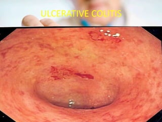 ULCERATIVE COLITIS
 
