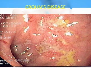 CROHN’S DISEASE
 