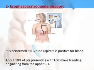 2- Esophagogastroduodenoscopy:




It is performed if NG tube aspirate is positive for blood.

About 10% of pts presenting with LGIB have bleeding
originating from the upper GIT.
 