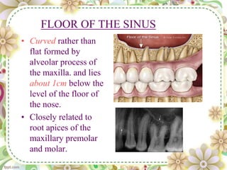 FLOOR OF THE SINUS
• Curved rather than
flat formed by
alveolar process of
the maxilla. and lies
about 1cm below the
level of the floor of
the nose.
• Closely related to
root apices of the
maxillary premolar
and molar.
 