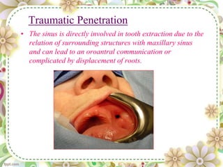 Traumatic Penetration
• The sinus is directly involved in tooth extraction due to the
relation of surrounding structures with maxillary sinus
and can lead to an oroantral communication or
complicated by displacement of roots.
 