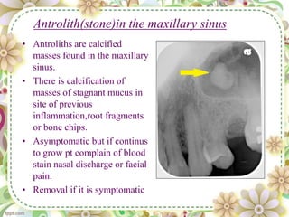 Antrolith(stone)in the maxillary sinus
• Antroliths are calcified
masses found in the maxillary
sinus.
• There is calcification of
masses of stagnant mucus in
site of previous
inflammation,root fragments
or bone chips.
• Asymptomatic but if continus
to grow pt complain of blood
stain nasal discharge or facial
pain.
• Removal if it is symptomatic
 