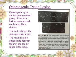 Odontogenic Cystic Lesion
• Odontogenic cysts
are the most common
group of extrinsic
lesions that encroach
on the maxillary
sinuses.
• The cyst enlarges ,the
sinus decrease in size
• The result is radio-
opaque line between
the cyst and the air
space of the sinus.
 